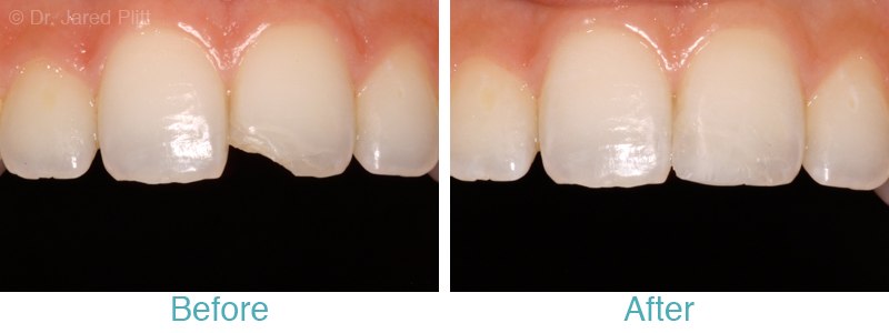 Resin Bonding to close spaces between lower front teeth and repair chipped  upper front tooth - Carroll Dental Care