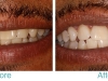 miami-beach-tooth-whitening-1