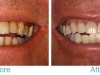 miami-beach-tooth-whitening-2