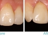 porcelain-crown-miami-beach-cosmetic-before-and-after-closeup