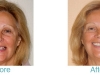 porcelain-crowns-miami-beach-cosmetic-dentist-1